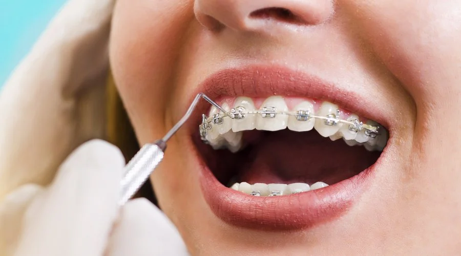 Imagen de brackets metálicos